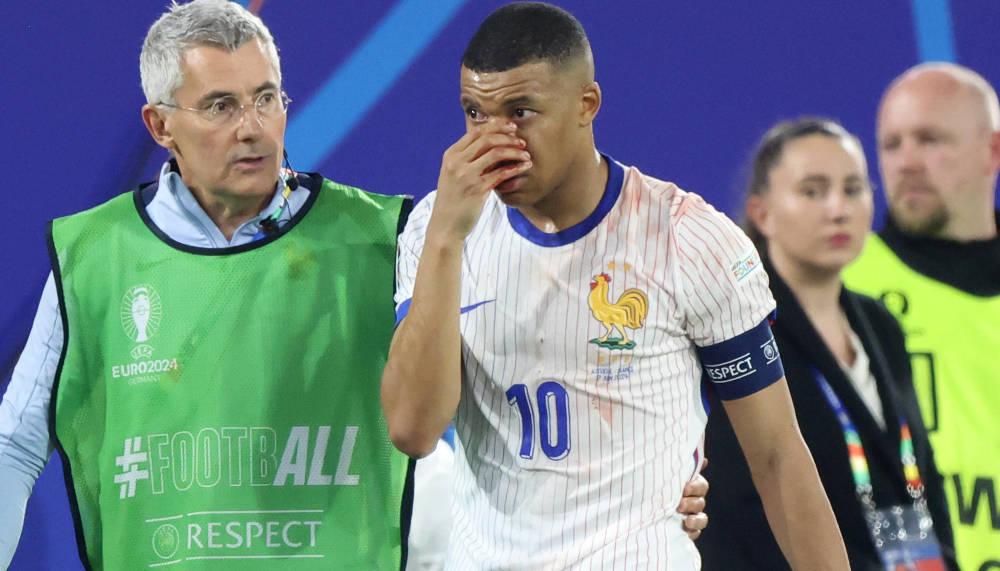 Mbappé muss nach Nasenbeinbruch mit Maske spielen